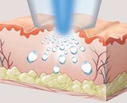 Clinic illustration of pressure-based delivery into skin. This is a simplified diagram, not a patient result or a depth measurement.