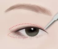 Eye Surgery