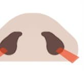 Clinic illustration of an incision used in one alar-reduction approach. Location depends on nostril anatomy.
