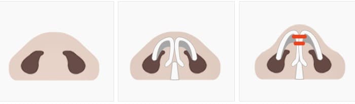 Nasal Tip Surgery