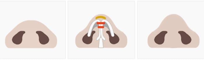 Another nasal-tip support approach illustrated by the clinic. Cartilage choice and suturing depend on examination.