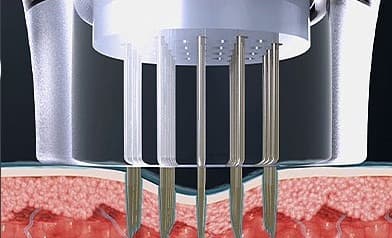 1. A microneedle tip approaches the skin. This simplified clinic illustration shows one tip type.