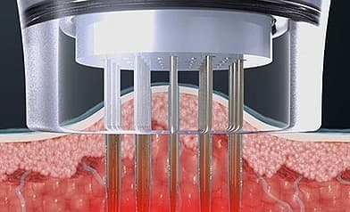 2. RF energy is delivered through the selected microneedle tip. Depth and settings are chosen by the doctor.