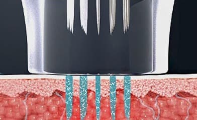3. The tip withdraws after energy delivery. The coloured areas illustrate treatment zones, not measured patient results.