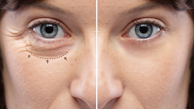 Under eye fat repositioning